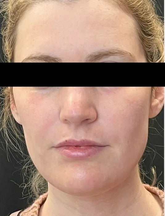 Laser Resurfacing, after treatment