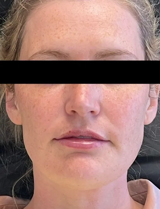 Laser Resurfacing, before treatment