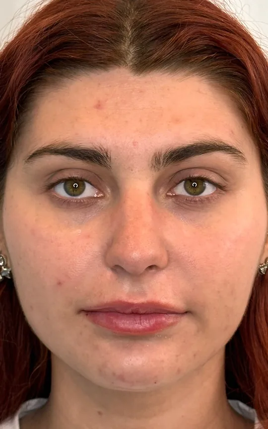 Lip Treatment, after treatment