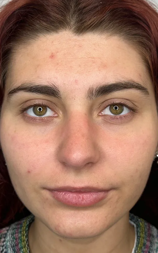 Lip Treatment, before treatment