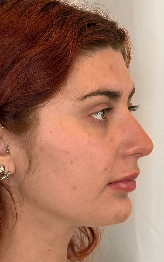 Lip Treatment, after treatment