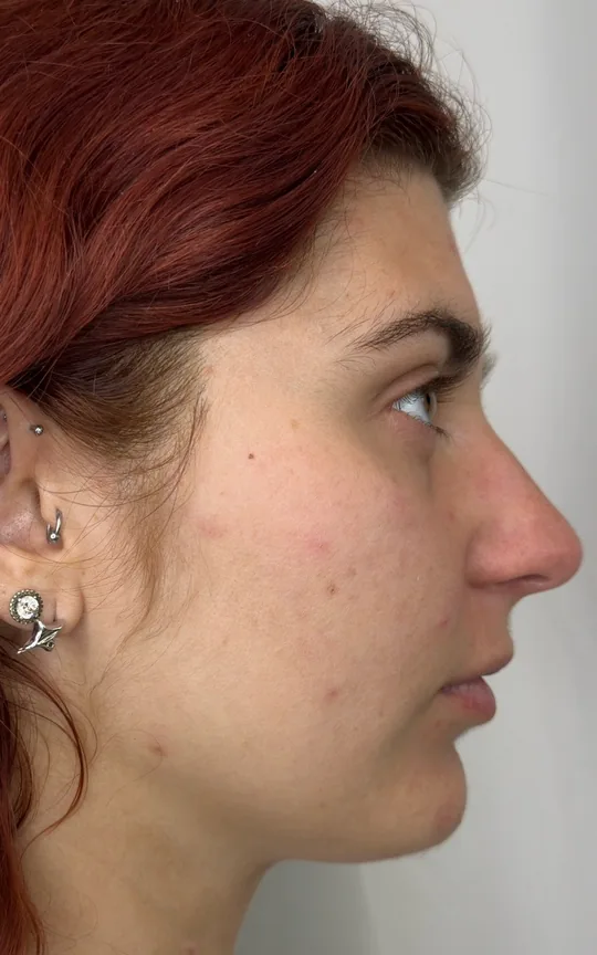 Lip Treatment, before treatment