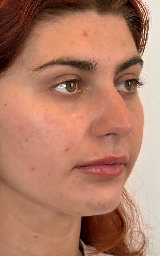 Lip Treatment, after treatment