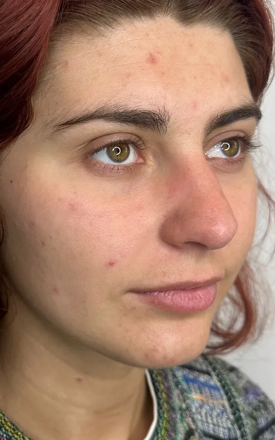 Lip Treatment, before treatment
