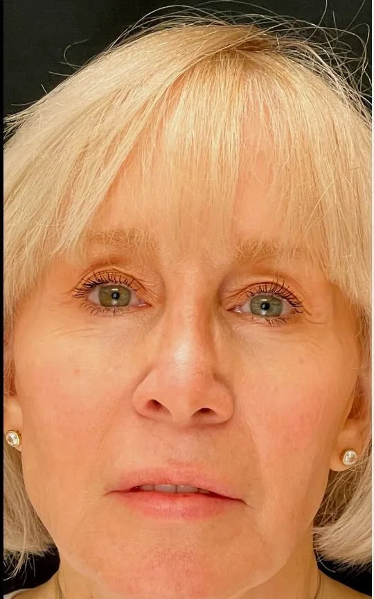 Botox and Dermal Filler, after treatment