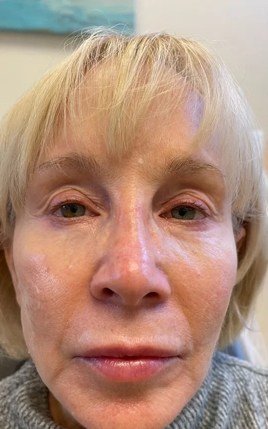 Botox and Dermal Filler, before treatment