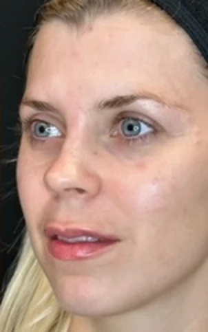Lips and Facial Balancing Using Fillers, after treatment