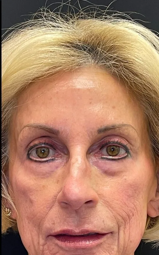Cheek and Marionette Filler, after treatment