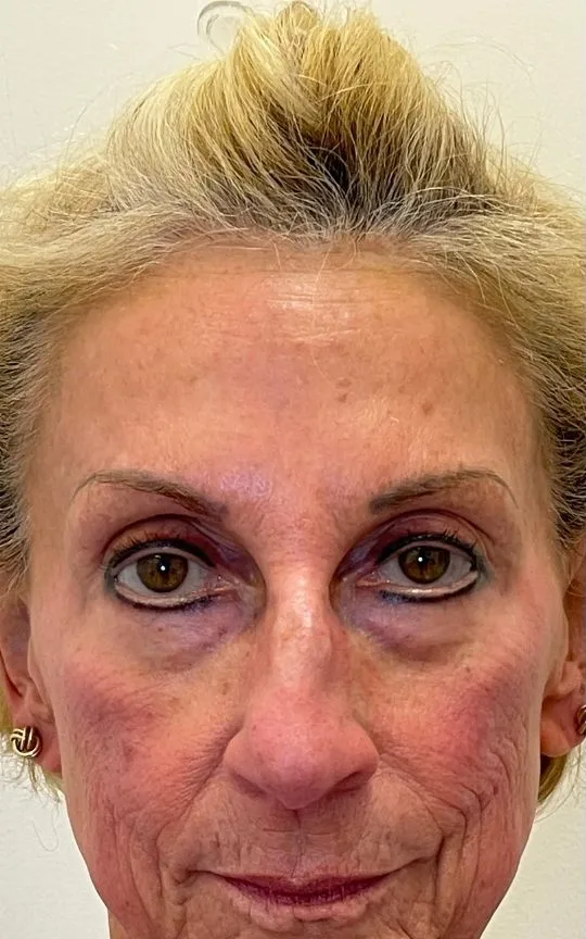 Cheek and Marionette Filler, before treatment