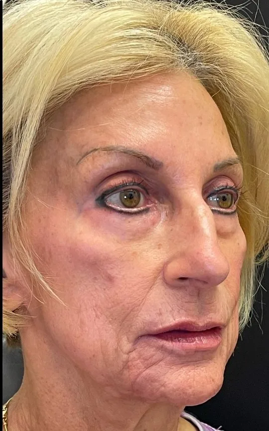 Cheek and Marionette Filler, after treatment