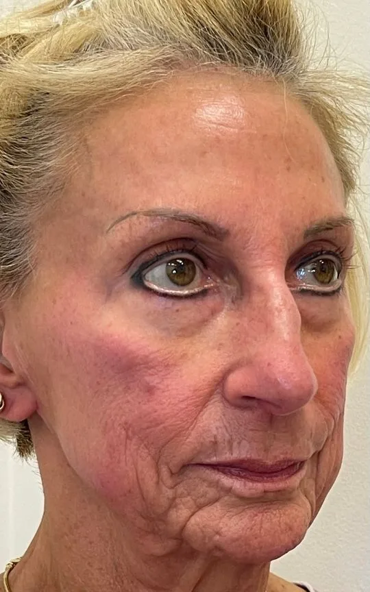 Cheek and Marionette Filler, before treatment