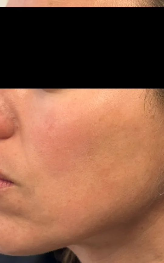 Skin Booster (Skinvive), after treatment