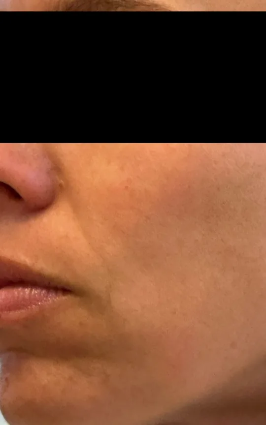 Skin Booster (Skinvive), before treatment