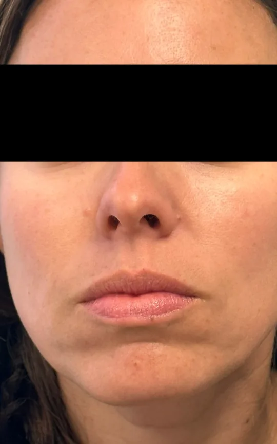 Skin Booster (Skinvive), after treatment