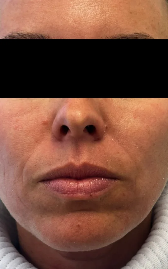 Skin Booster (Skinvive), before treatment