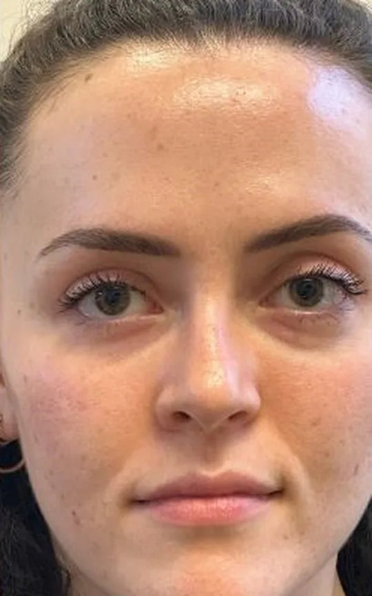 Tear Trough (Under Eye), after treatment