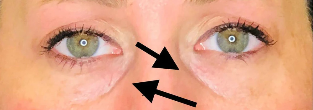 Tear Trough (Under Eye), before treatment