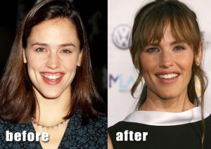 jen garner gummy smile