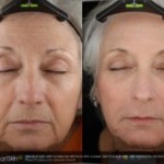 Laser Resurfacing before and after