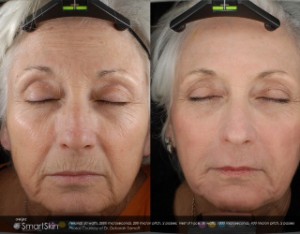 Laser Resurfacing before and after