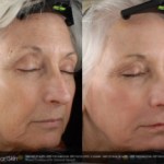 Laser Resurfacing before and after