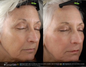 Laser Resurfacing before and after