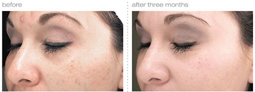 Chemical Peel before and after