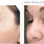 Chemical Peel before and after