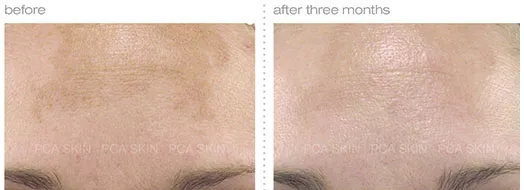 Chemical Peel before and after