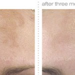 Chemical Peel before and after