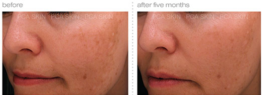 Chemical Peel before and after