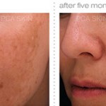 Chemical Peel before and after