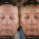 Laser Resurfacing before and after