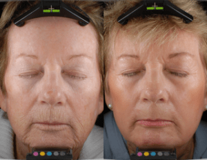 Laser Resurfacing before and after