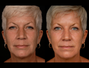 Laser Resurfacing before and after