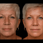 Laser Resurfacing before and after