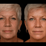 Laser Resurfacing before and after