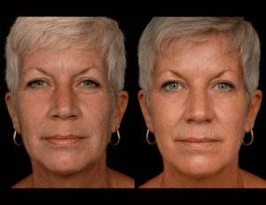 Laser Resurfacing before and after