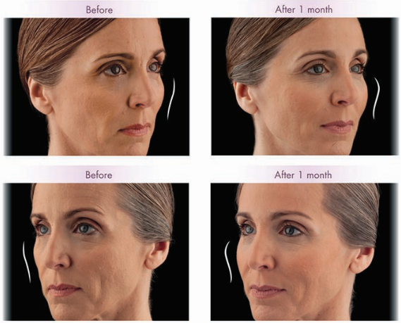 Before and after Voluma XC
