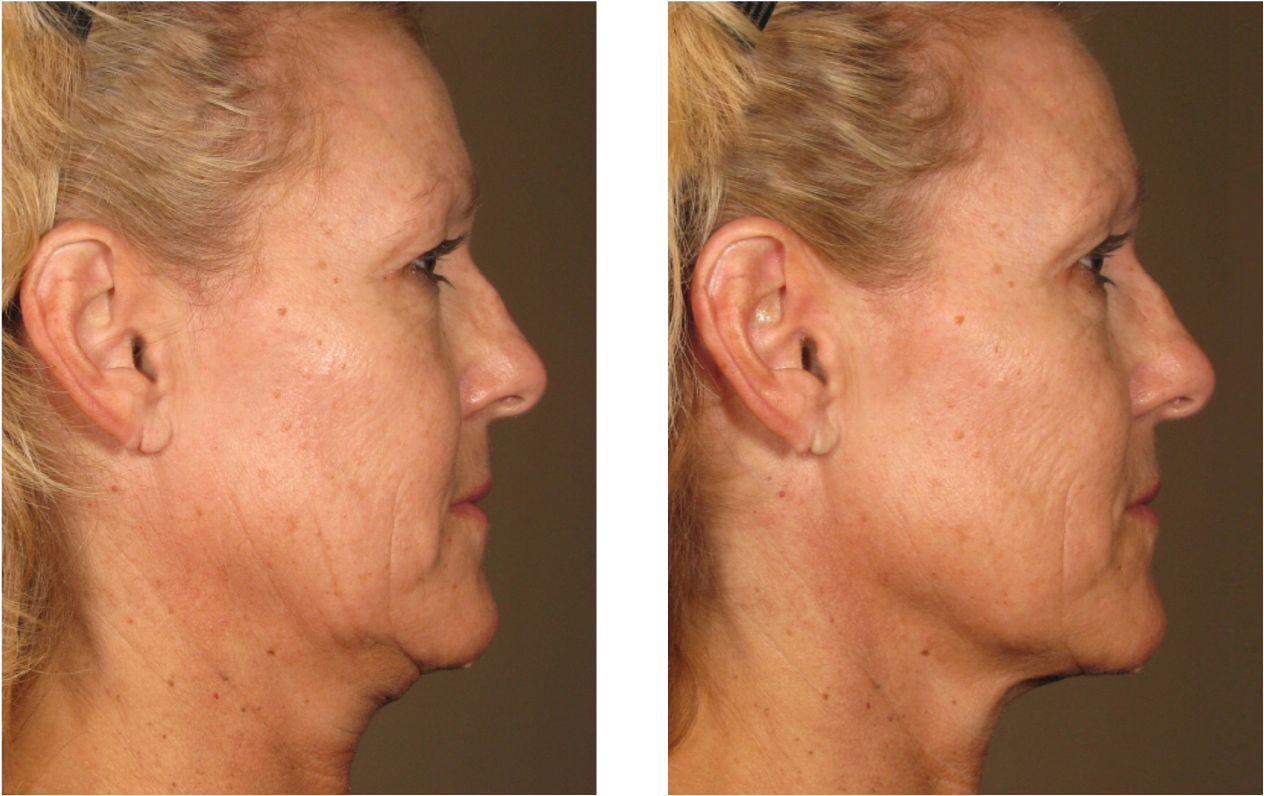 Before and after Ultherapy