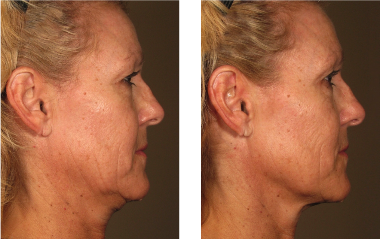 Before and after Ultherapy