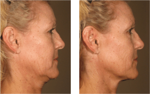 Before and after Ultherapy