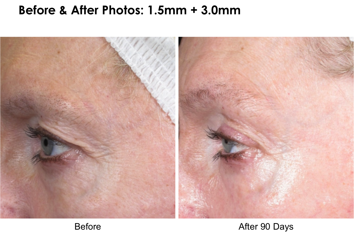 Before and after Ultherapy