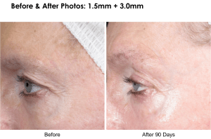 Before and after Ultherapy