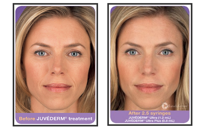 Before and after Juvederm