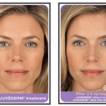 Before and after Juvederm