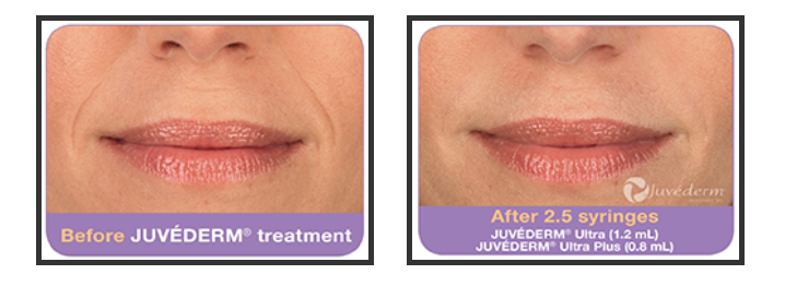 Before Juvederm and after 2.5 Juvederm syringes