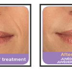 Before Juvederm and after 2.5 Juvederm syringes