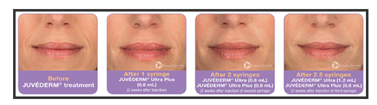 Before and after Juvederm