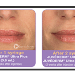 Before and after Juvederm